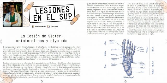 Lesiones en el SUP: La lesión de Slater versión española